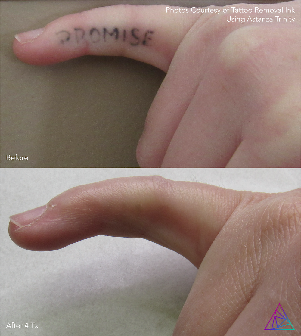 Before and after tattoo removal